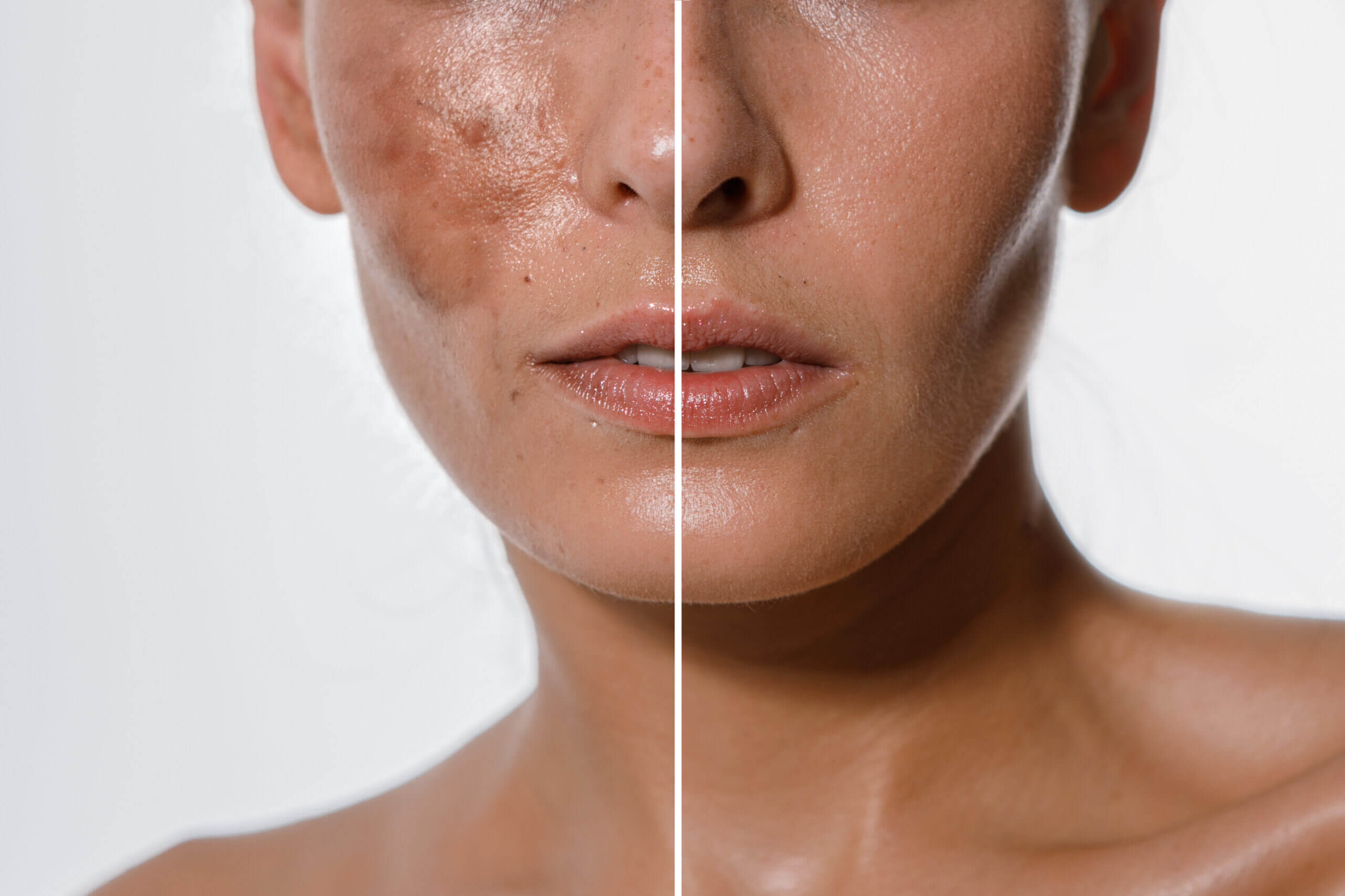 Hyperpigmentation Treatment Before and After Photos | Estevez Aesthetics in Las Vegas, NV