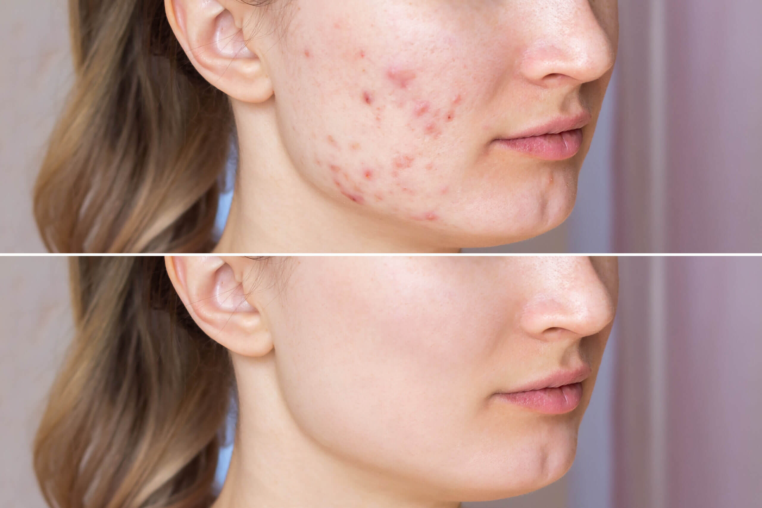 Laser Acne Treatment Before and After Photos | Estevez Aesthetics in Las Vegas, NV