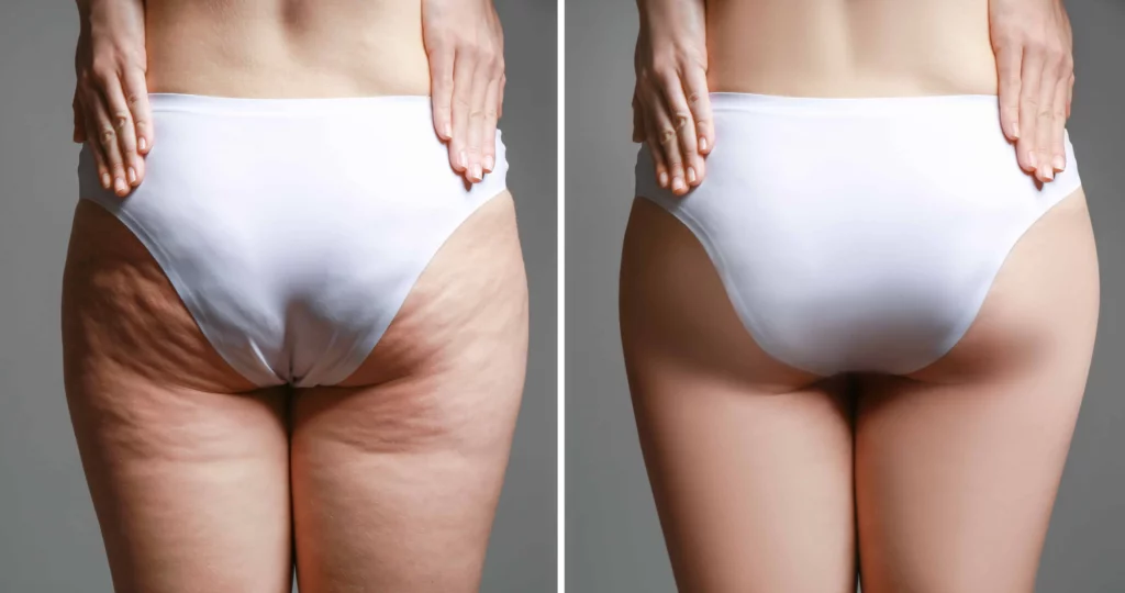 Laser Cellulite Reduction in Las Vegas, NV | Estevez Aesthetics