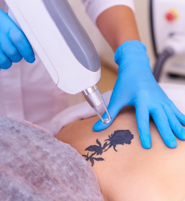 Laser Tatto Treatment in Las Vegas, NV | Estevez Aesthetics