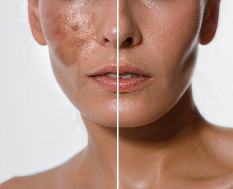 Hyperpigmentation Treatment Before and After Photos | Estevez Aesthetics in Las Vegas, NV