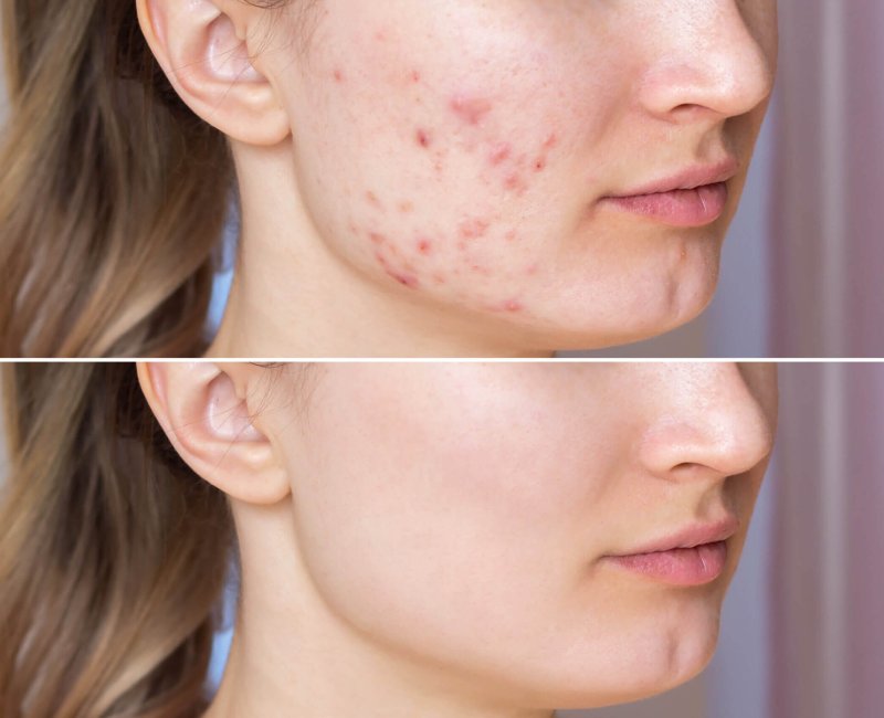 Laser Acne Treatment Before and After Photos | Estevez Aesthetics in Las Vegas, NV